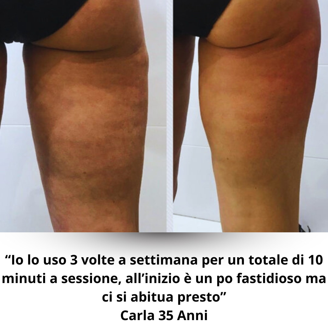 Helmedic™- Cups Anti Cellulite