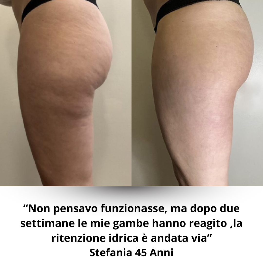 Helmedic™- Cups Anti Cellulite